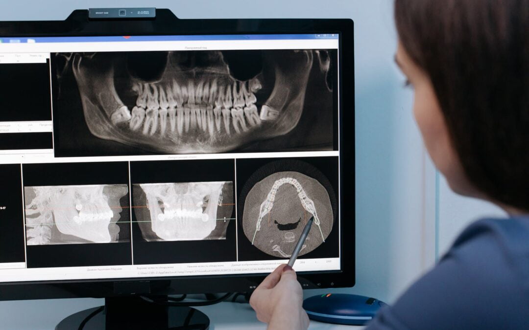 Denti fissi in 6 ore a Roma: come funziona il carico immediato?