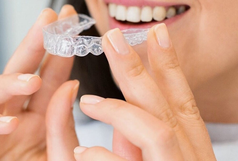 Ortodonzia trasparente