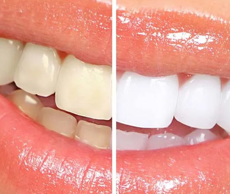 Sbiancamento dentale